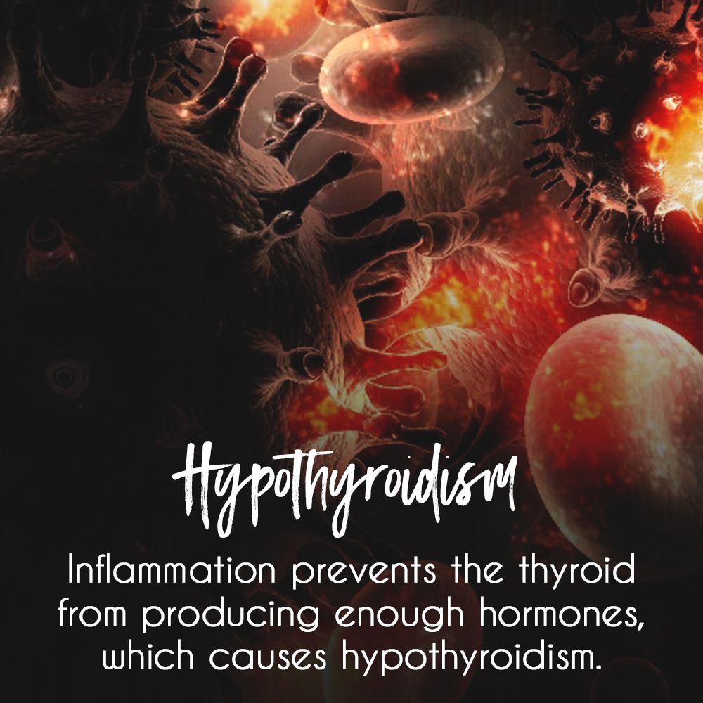 Unraveling the Complex Causes of&nbsp;Hypothyroidism